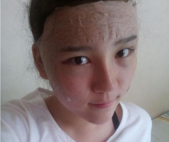 奇异果app：实拍：90后女子整容手术全历程用30天时候从“丑女”变美女(图3)