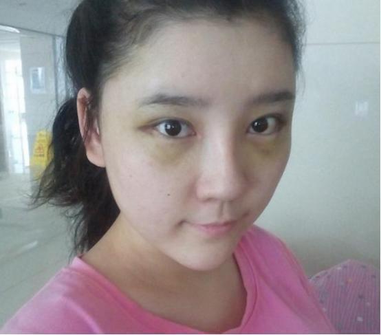 奇异果app：实拍：90后女子整容手术全历程用30天时候从“丑女”变美女(图4)