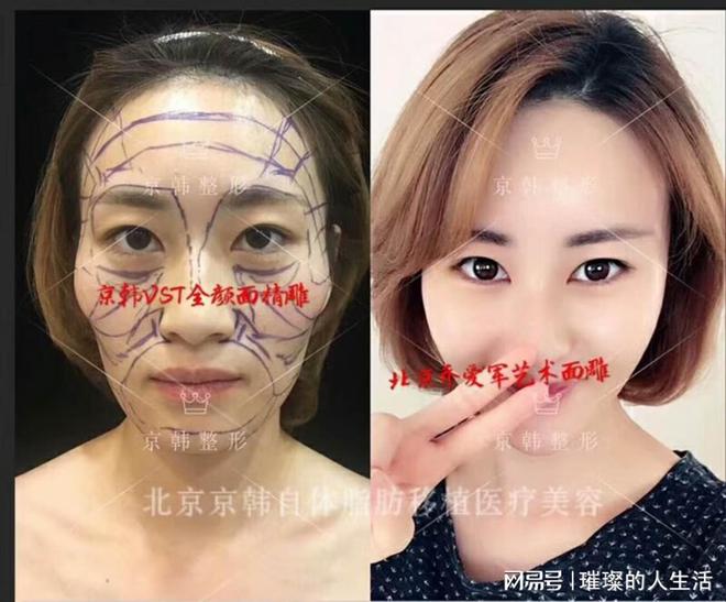奇异果app官网下载：北京面部脂肪填充大夫排名填充还原经过(图1)